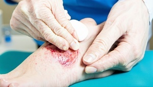 Wound treatment 